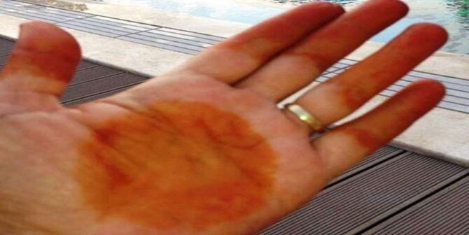 *Okan Üniversitesi Hastanesi Nöroloji Uzmanı Prof. Dr. Okan Bölükbaşı, ‘’Kına