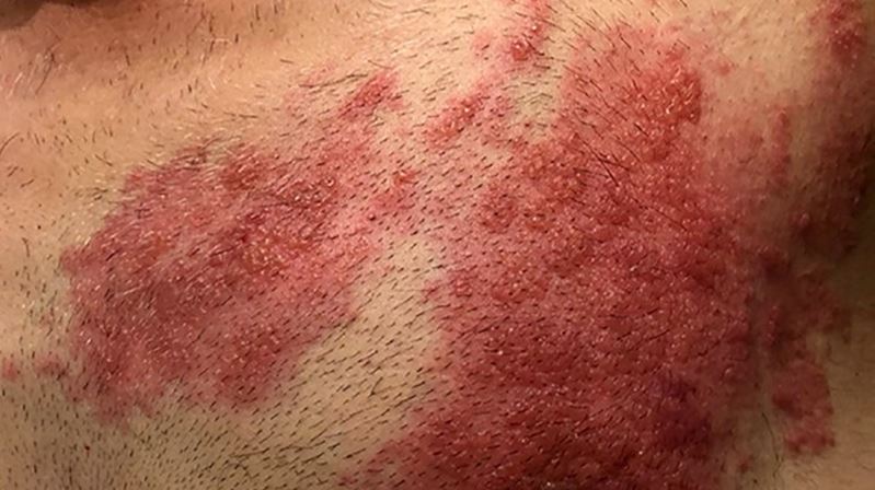 Daha çok 50 yaş üstü bireylerde görülen zona hastalığı ile